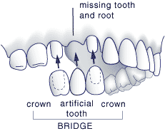 first bite dental cosmetic dentistry bridge