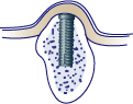 first bite dental dental implants implant3