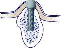 first bite dental dental implants implant4