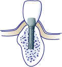 first bite dental dental implants implant5