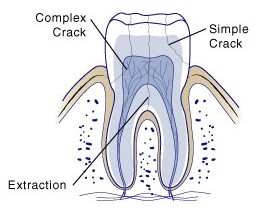 first bite dental general dentistry dgrm-cracked-tooth