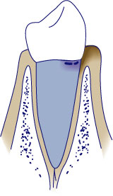 Early Periodontitis Early Periodontitis
