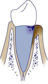 Moderate Periodontitis Moderate Periodontitis