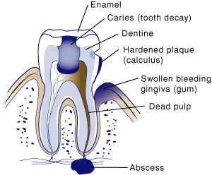 first bite dental general dentistry tooth decay treatment dgrm-diseasedtooth