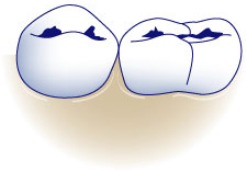 first bite dental general dentistry tooth decay treatment fissure-carries