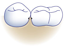 first bite dental general dentistry tooth decay treatment proximal-carries Proximal Caries