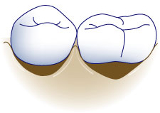 first bite dental general dentistry tooth decay treatment root-carries