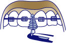 first bite dental orthodontics braces-inter