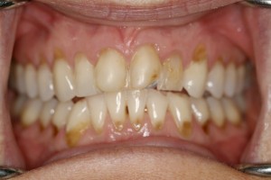 Dental-Erosion essendon dentist