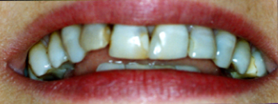 Patient before dental veneers