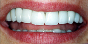 Patient after porcelain veneers.