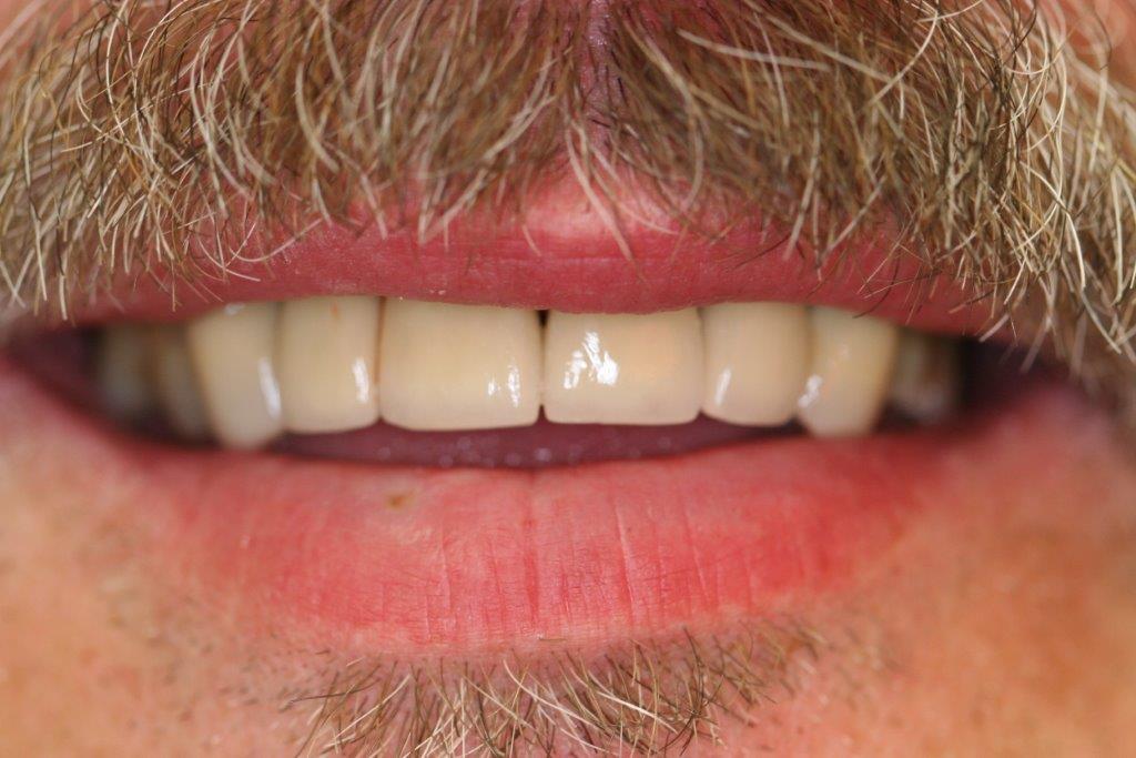 Image of patient's teeth after mini dental implants
