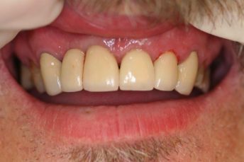 Image of patient's teeth before mini dental implants