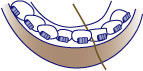 How to floss with braces and bridges