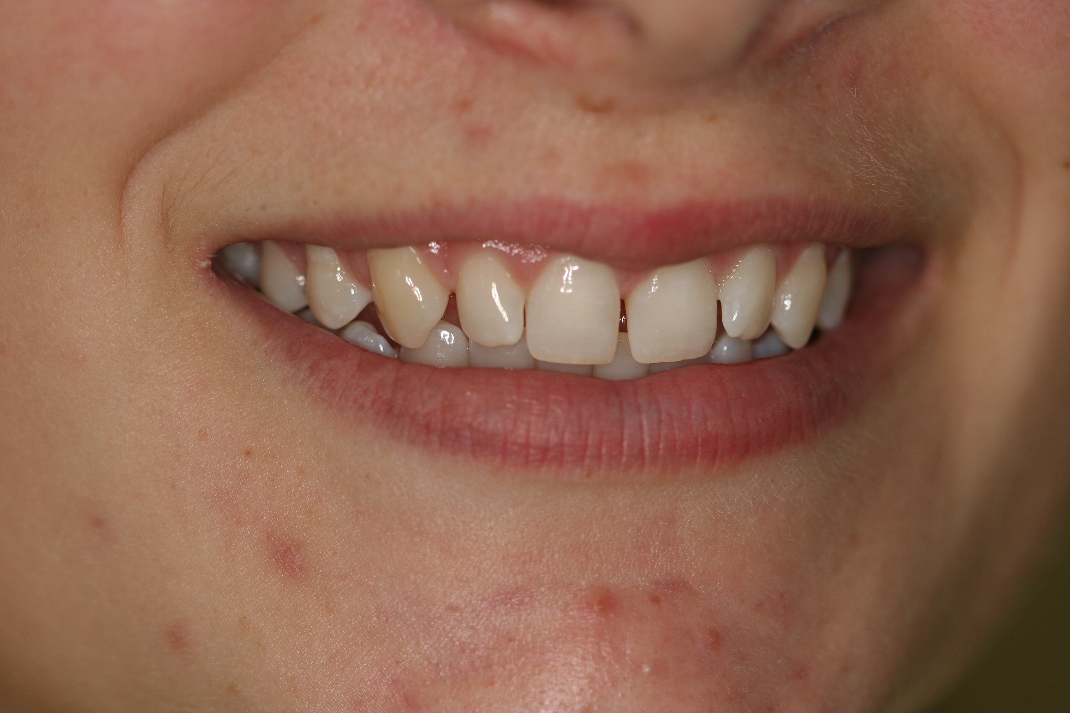 teeth before treatment picture
