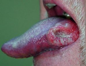 Oral Cancer 2 Essendon Dentist
