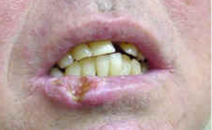 Oral Cancer Essendon Dentist