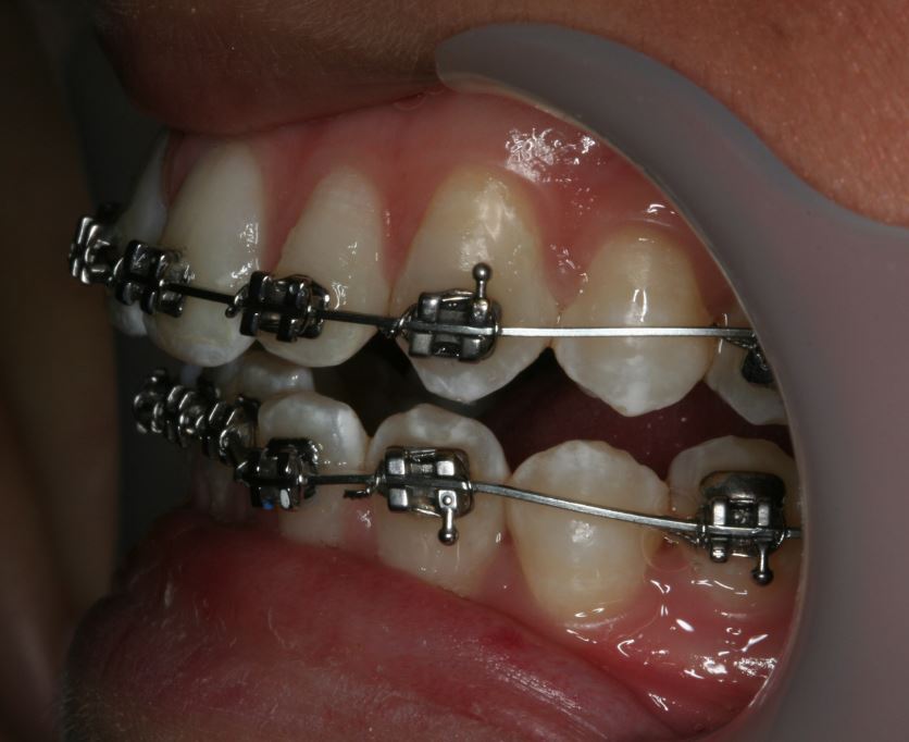 Gummy Smile and Deep Bite