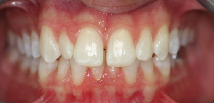 Essendon Dentist Gummy Smile and Deep Bite