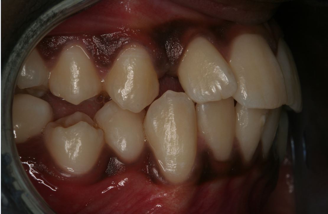 Canine Exposure Orthodontics