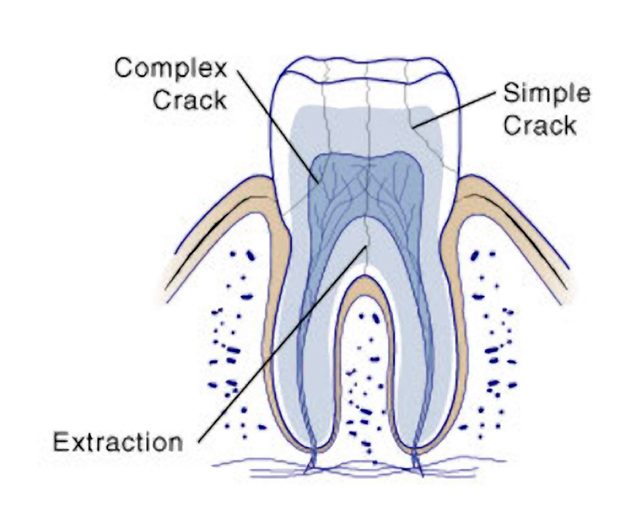 Cracked-Tooth-syndrome-christmas-dentist-broken-tooth