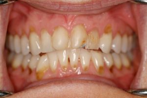 Dental-Erosion-teeth-rotten-oral-health-disease