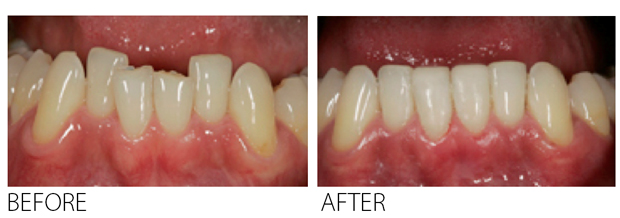 Invisible-Braces-invisalign-tru-line