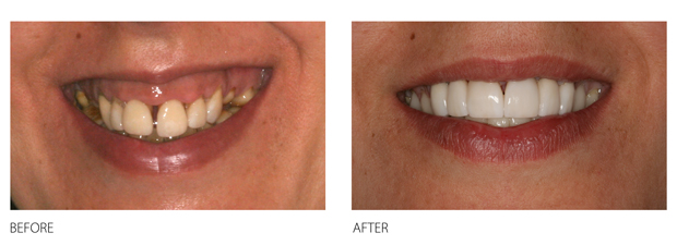 Major-Reconstructions-teeth-smile