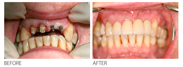 mini-implants-dental-teeth