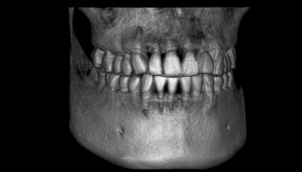 xray 3D dental implants imaging