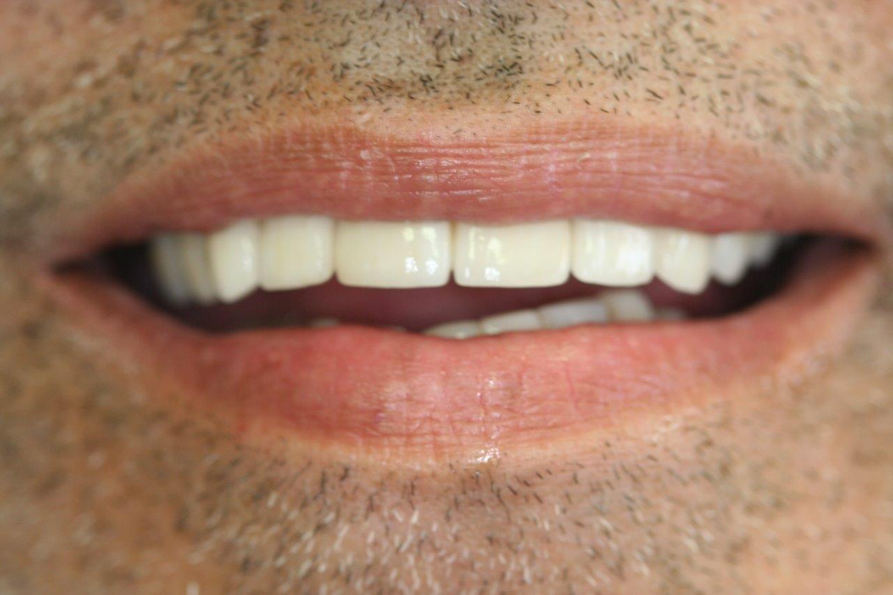 Crowns After