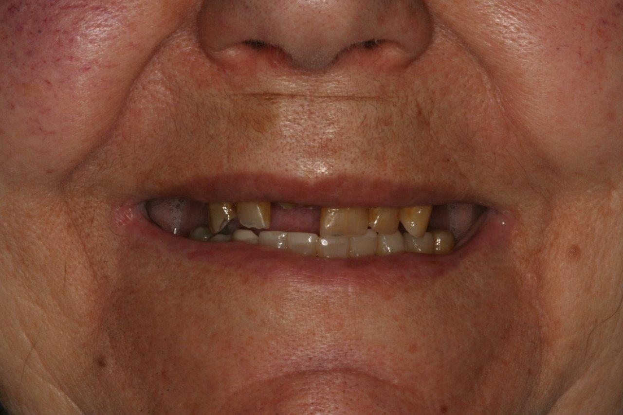 Chrome Denture Essendon