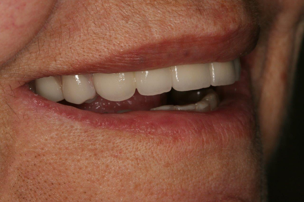 Denture Finish Essendon
