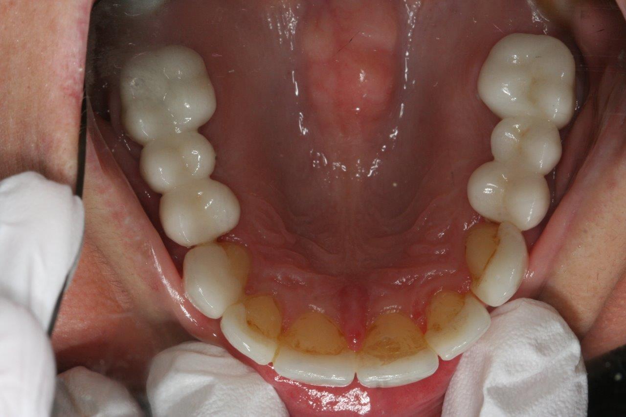 teeth after treatment