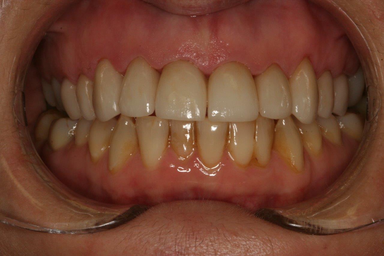 Porcelain Crowns Essendon