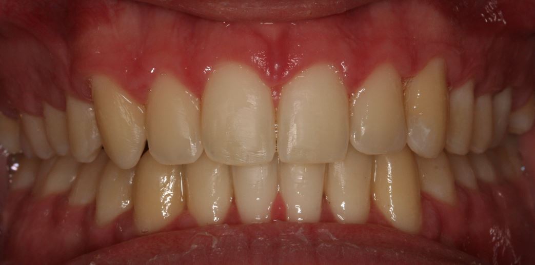peg laterals composite veneer firstbite essendon