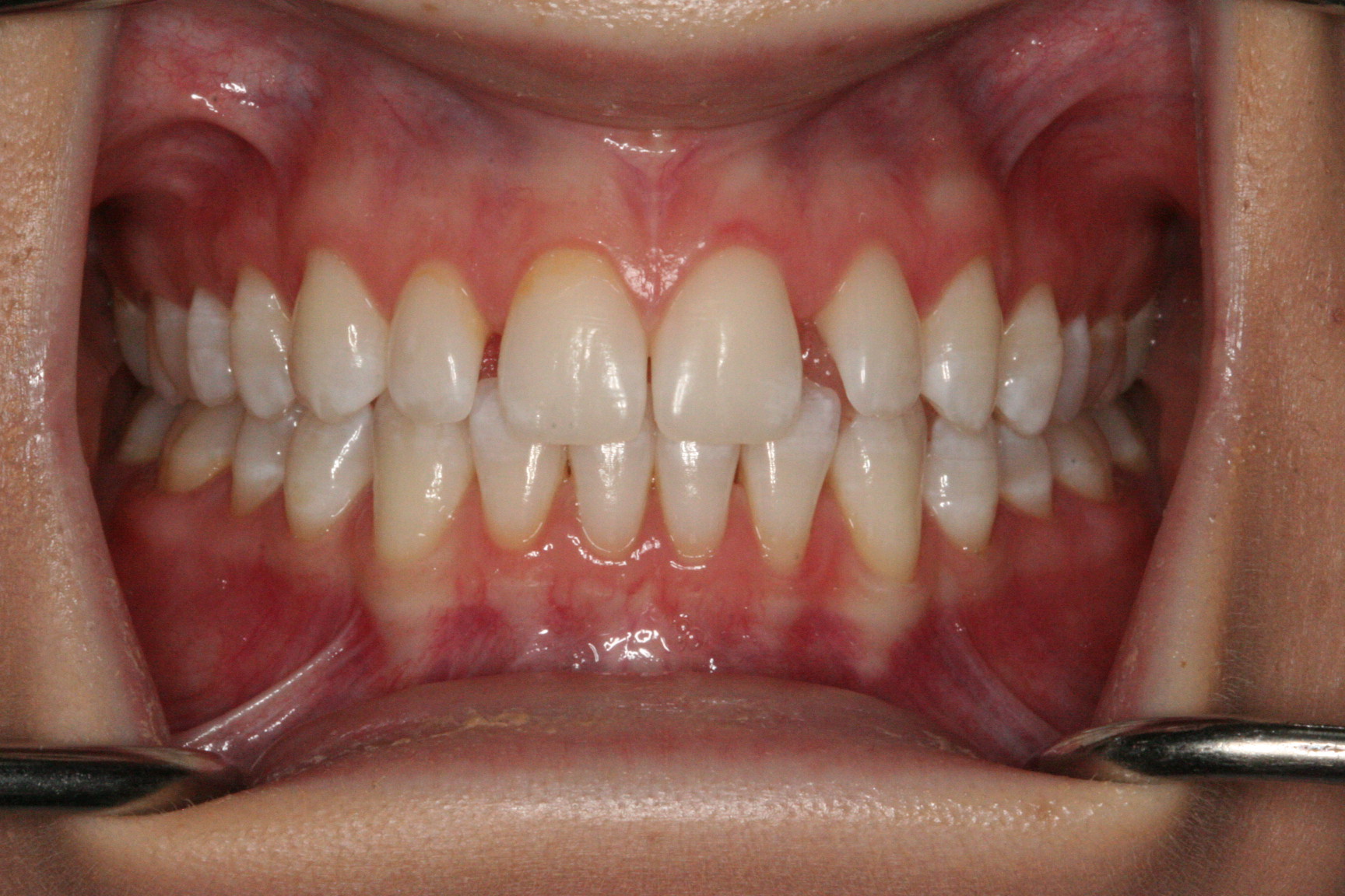 Composite Veneers essendon dentist