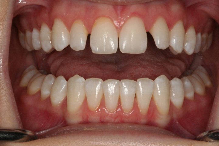 Composite Veneers Essendon Dentist