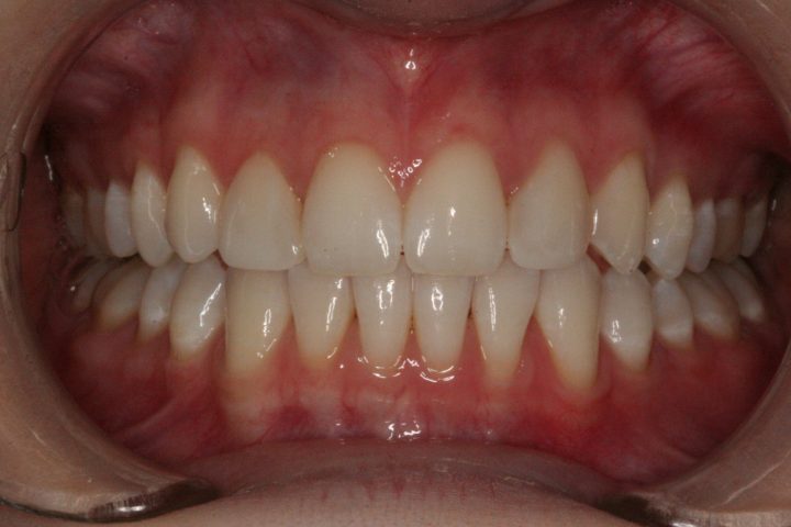 Composite Veneers Essendon Dentist
