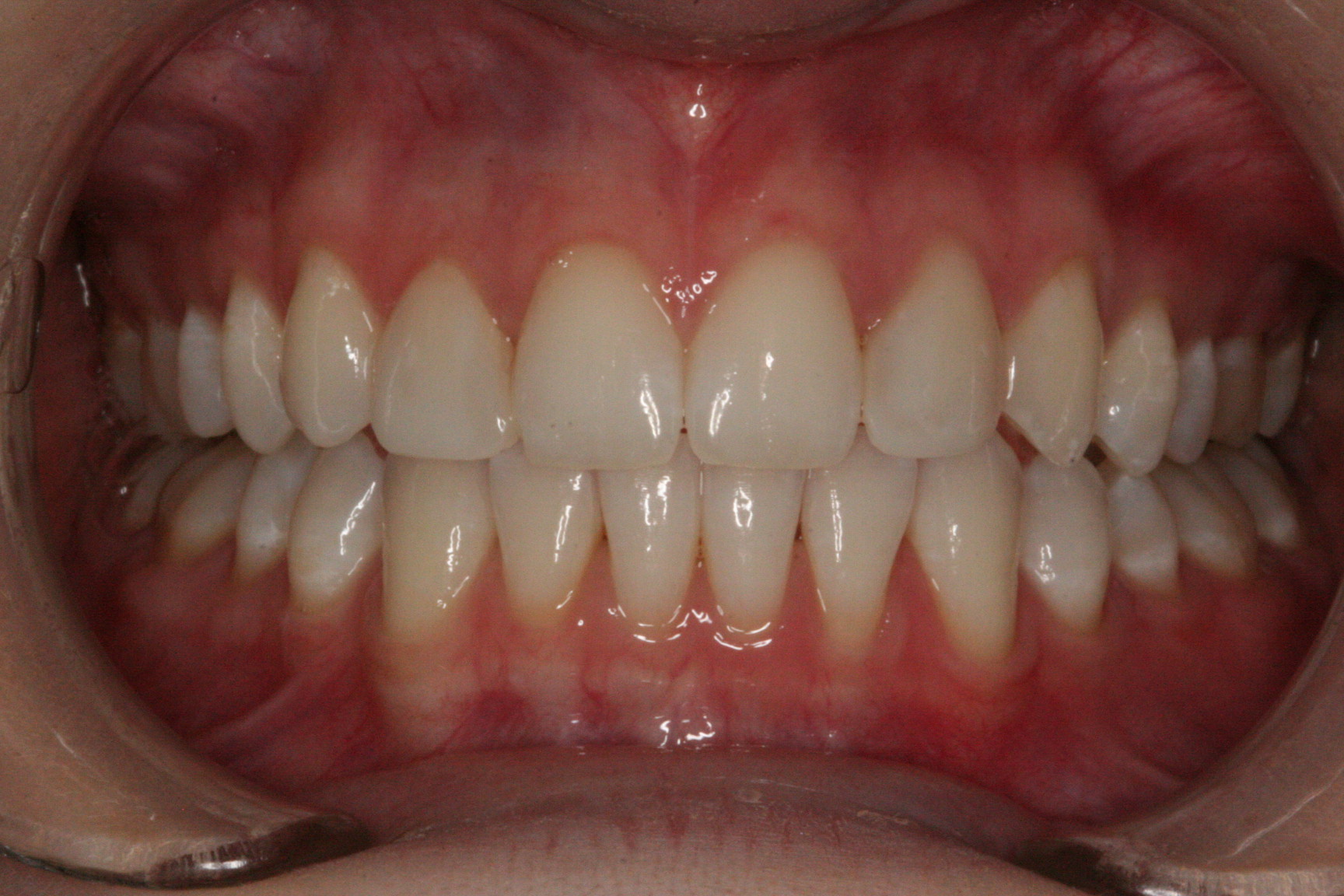 Composite Veneers Essendon Dentist