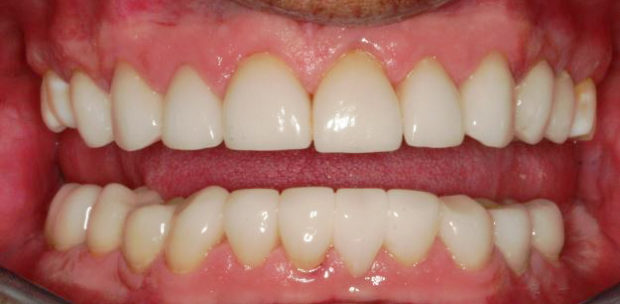 firstbite-dental-implants-essendon-Worn-Dentition-After