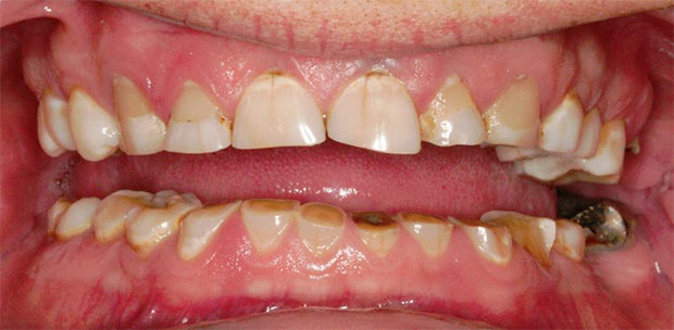 firstbite-dental-implants-essendon-Worn-Dentition-Before