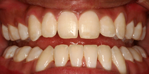Braces After FirstBite Dental Essendon
