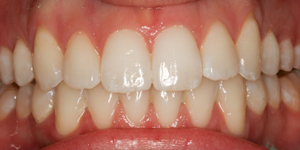 Invisalign After FirstBite Dental Essendon