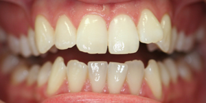 Invisalign Before FirstBite Dental Essendon