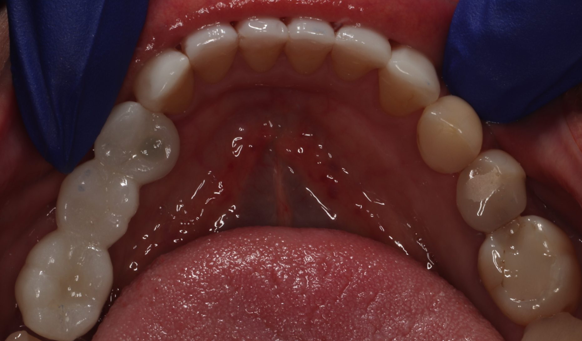 implant bridge after