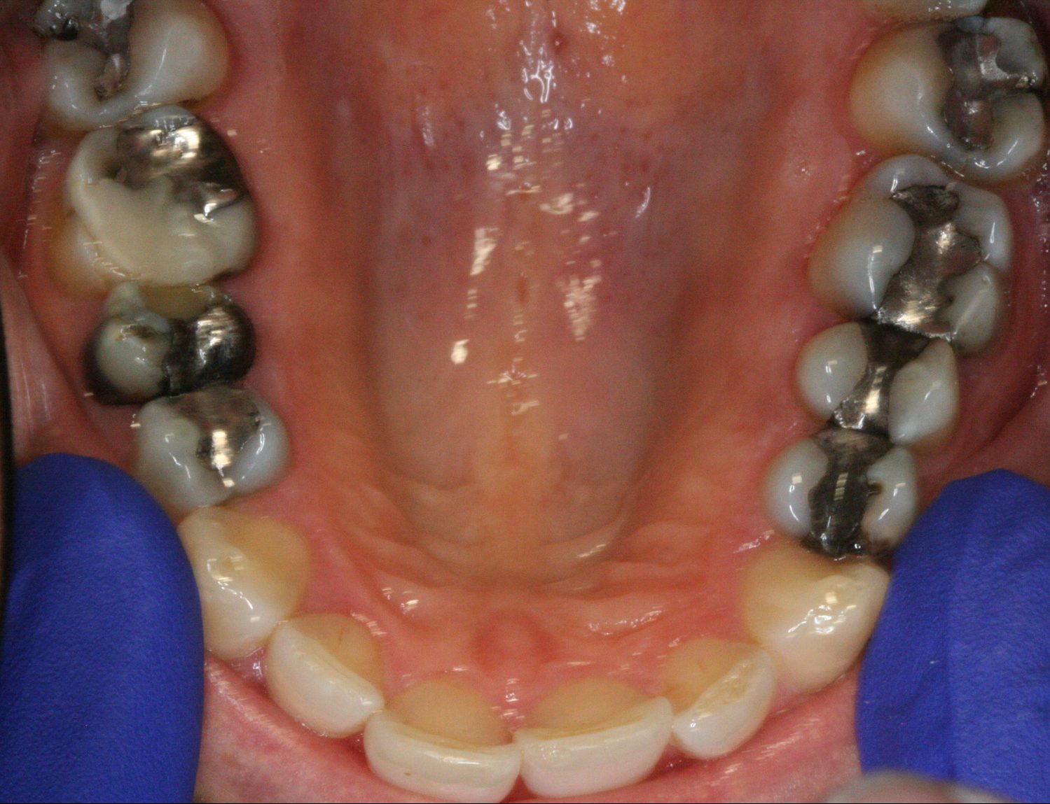 white fillings before essendon