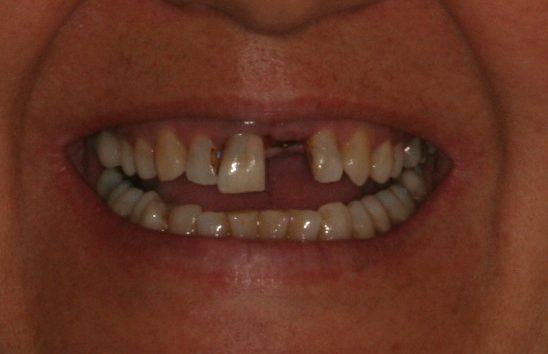 dental implants and crowns