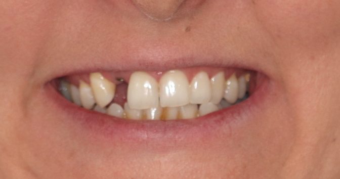 missing front tooth