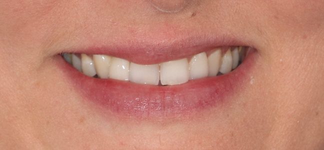 dental implant missing front tooth
